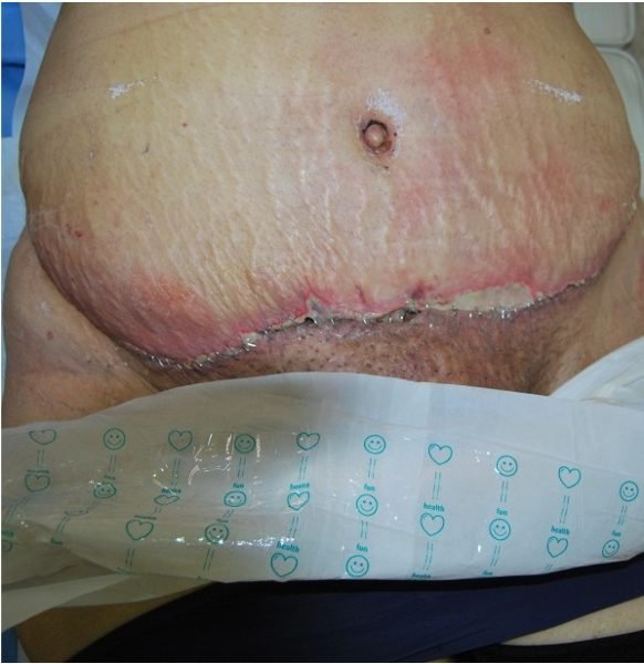 Day 7: lower abdominal wound breaking down after tummy tuck