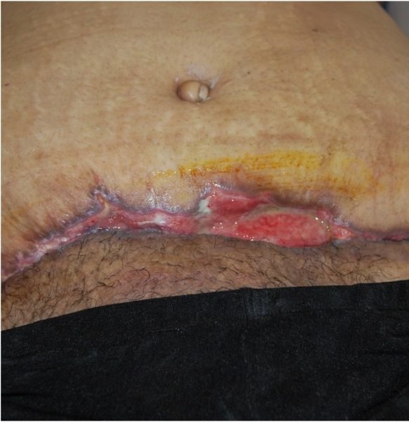 Week 2: wound filled with healthy granulation tissue