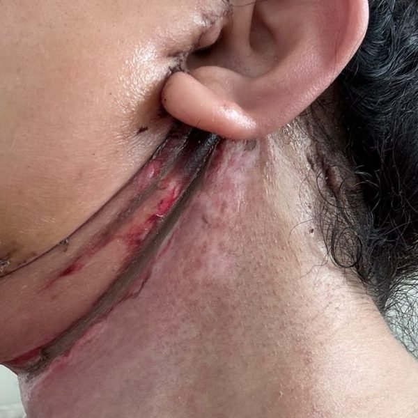 Darkened skin and opening wound along the neck lift incision