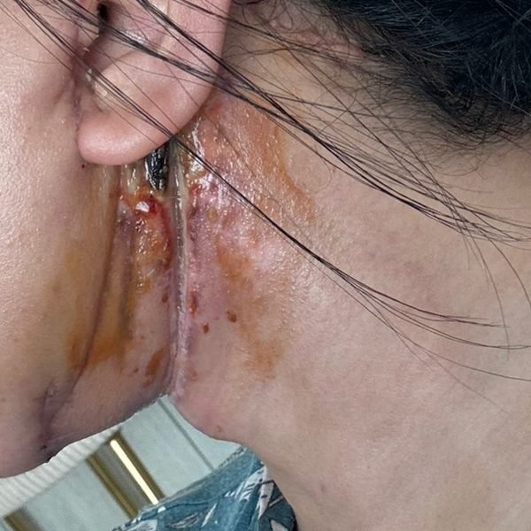 Sloughing wound behind the ear and on the neck at first visit