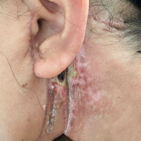 Close-up of slough behind the ear after facelift