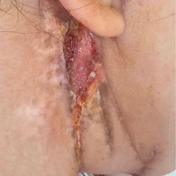 Wound behind the ear with granulation tissue during treatment