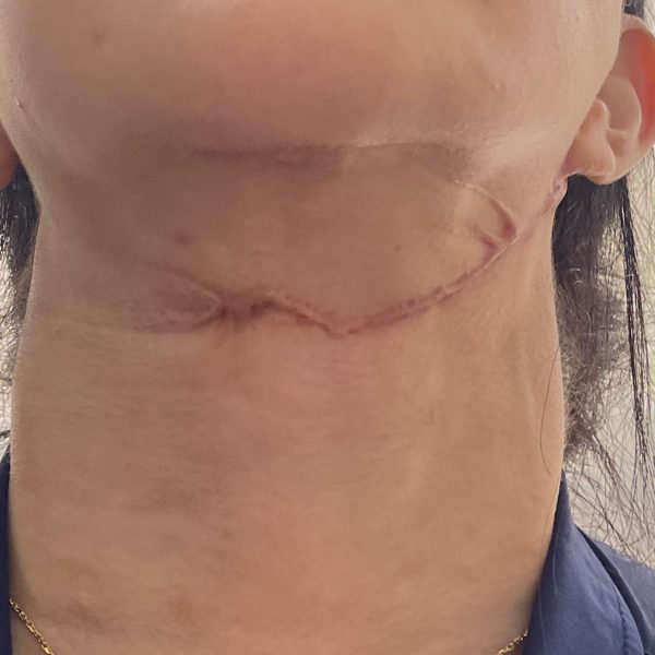 Healed neck scar seen from below