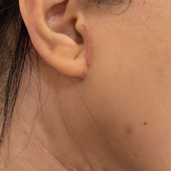 Healed scar in front of and below the ear, close-up