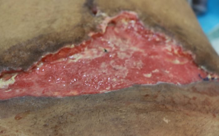Large open lower abdominal wound after debridement of tummy tuck skin necrosis