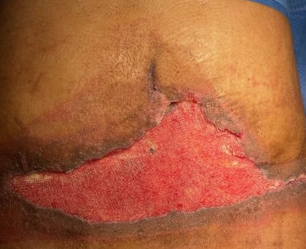 Lower abdominal wound with healthy granulation tissue after VAC therapy