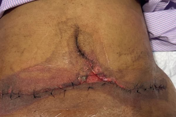 Abdominal flap advanced with anchoring sutures, small area left open