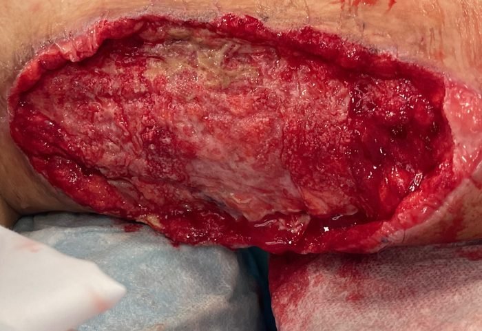 Large open arm wound after necrotising fasciitis following arm lift
