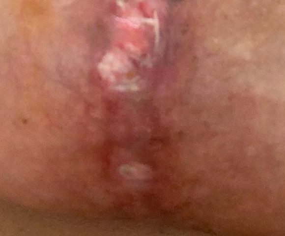 Discharging wound with suture granulomas along the vertical scar after breast reduction