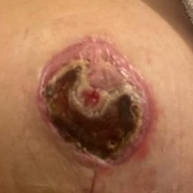 Eschar separating from the nipple-areola after silver sulfadiazine dressings
