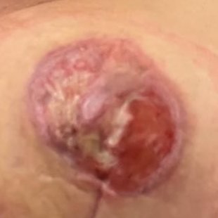 Nipple-areola wound bed healing with new skin after PRP