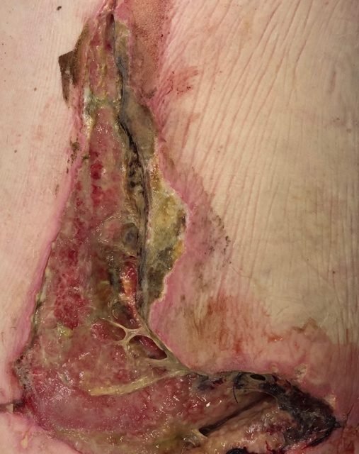 Extensive infected back wound after blast injury at first visit