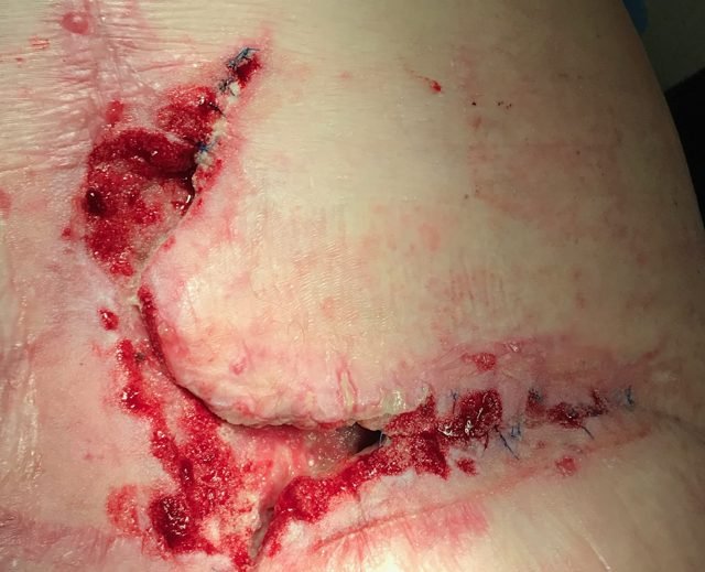 Small rotation flap with anchoring sutures on the lower back