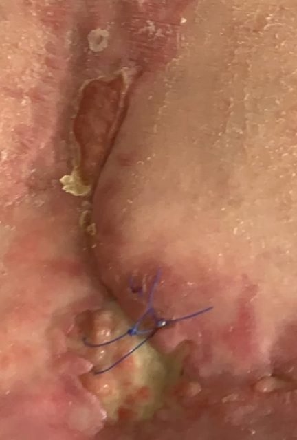 Back wound closing after flap and VAC